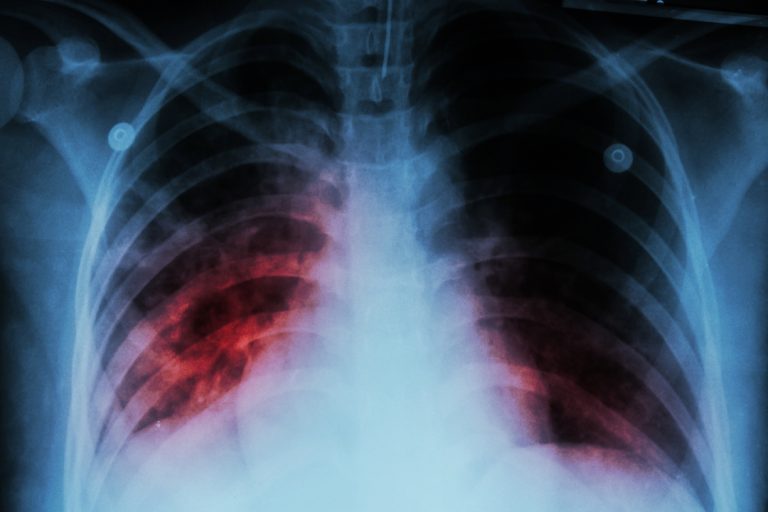 The CDC reported a large outbreak of multidrug-resistant tuberculosis