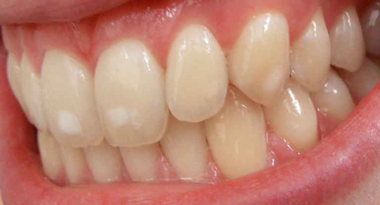 Drs. H. Trendley Dean and Elias Elvove started work on the mystery of “mottled enamel” — later called fluorosis