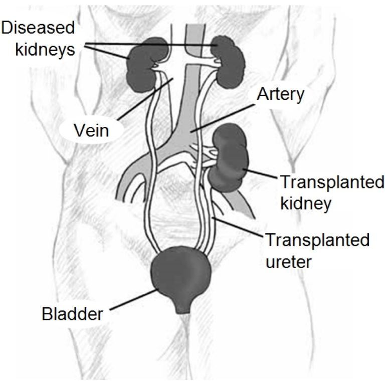 Researchers develop model for real-time monitoring of kidney transplants