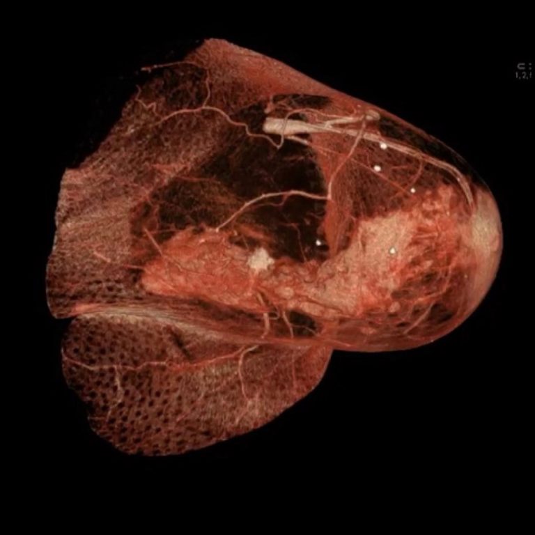 A novel approach to treatment of solid cancers involved therapeutic agents that inhibit the generation of new blood vessels in growing tumors