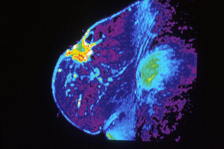Thousands of people could benefit from new twice-a-day tablet for advanced breast cancer