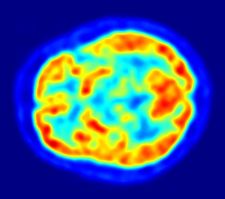 Study found no link between migraine and Parkinson’s disease