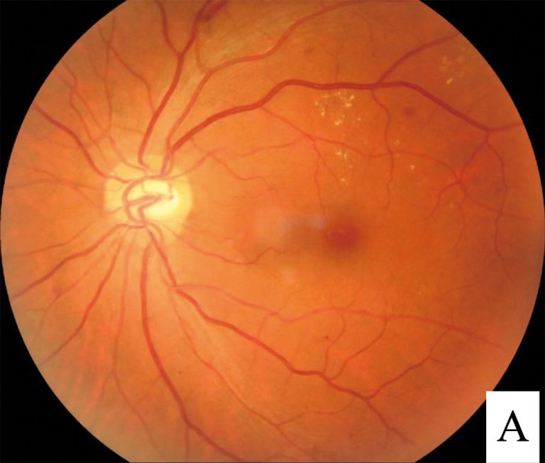 FDA Approves Genentech’s Susvimo as the First and Only Continuous Delivery Treatment for the Leading Cause of Diabetes-Related Blindness