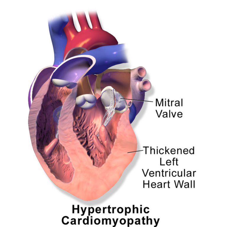 Southwestern designated Hypertrophic Cardiomyopathy Center of Excellence