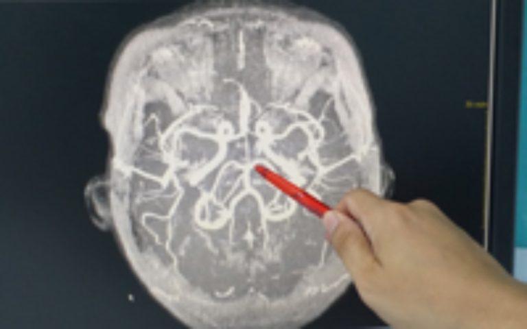Study revealed how deadly brain tumor evades treatment; identifies potential new treatment strategy