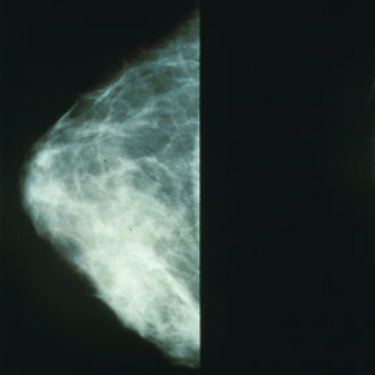 National Cancer Institute and ACRIN launched first multicenter study to compare digital mammography
