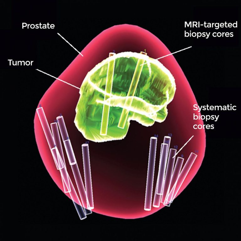 National Cancer Institute researchers discovered common variation in a gene segment that increases risk for prostate cancer