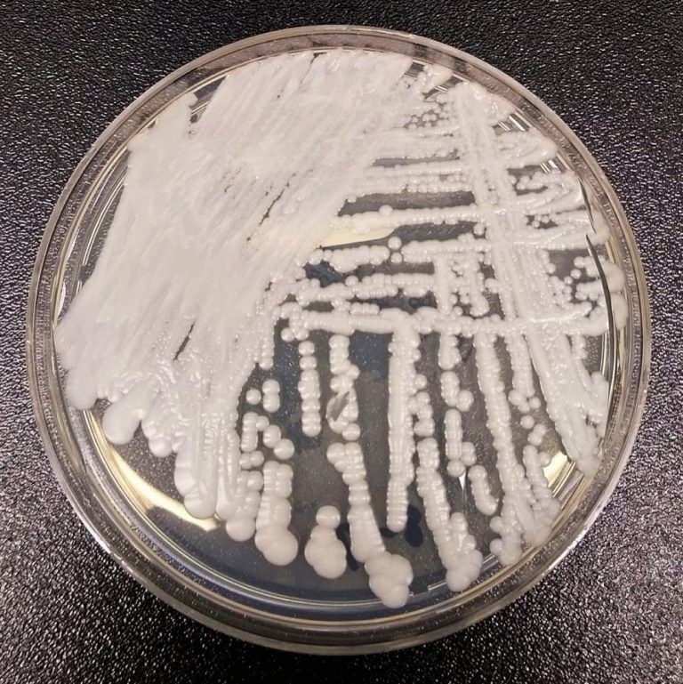 First case of Candida auris reported in Washington with local transmission suspected