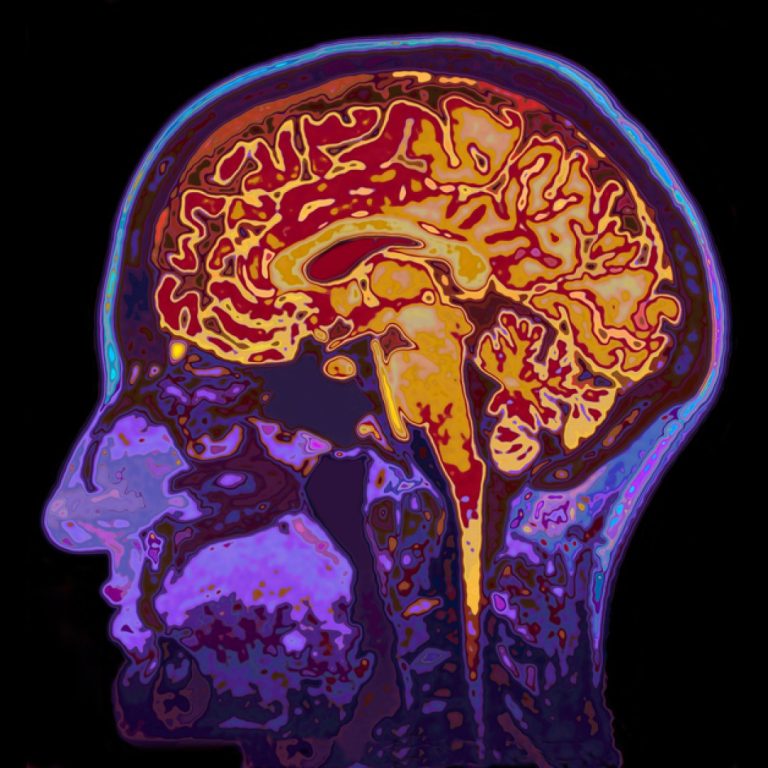 $10 million gift to UCLA from Wendy and Leonard Goldberg largest ever to support migraine research