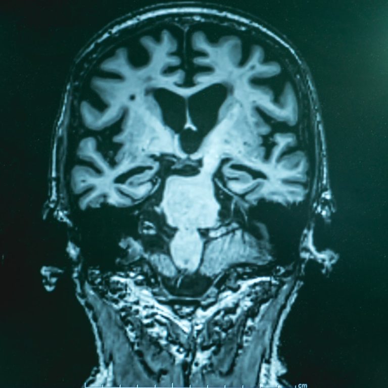 Largest international study of Alzheimer’s genes was published