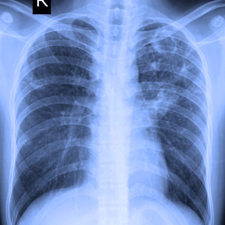 New cancer diagnoses fell abruptly early in the COVID-19 pandemic according to Annual Report to the Nation