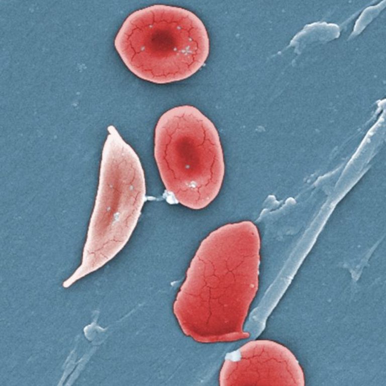 Sickle Cell Disease Awareness Month was Established
