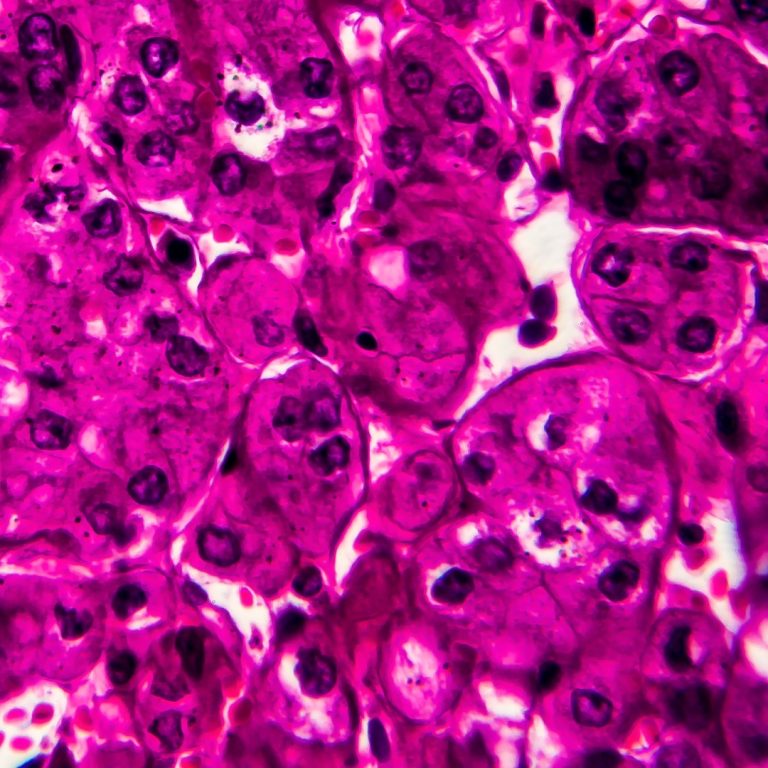 Stanford researchers discovered a molecule that kills kidney cancer cells