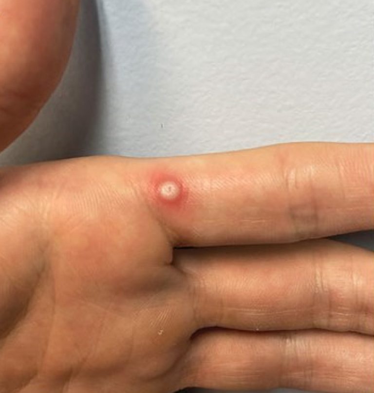 WHO approved first mpox diagnostic test for emergency use, boosting global access