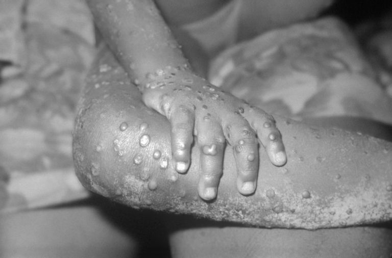 first human case of mpox Reported in the Democratic Republic of Congo