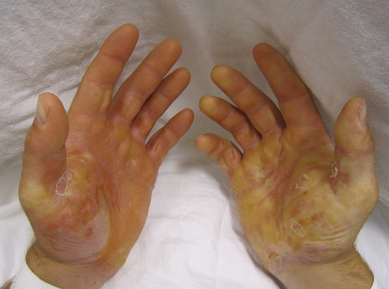 EB was first described by Ferdinand Ritter Von Hebra, an Austrian physician and dermatologist