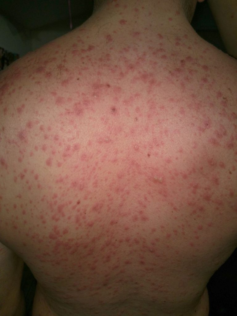 World-first cure for lethal skin disease achieved in landmark study