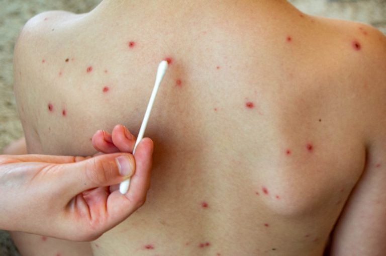 The Colorado Department of Public Health identified Measles case in Pueblo County, Colorado