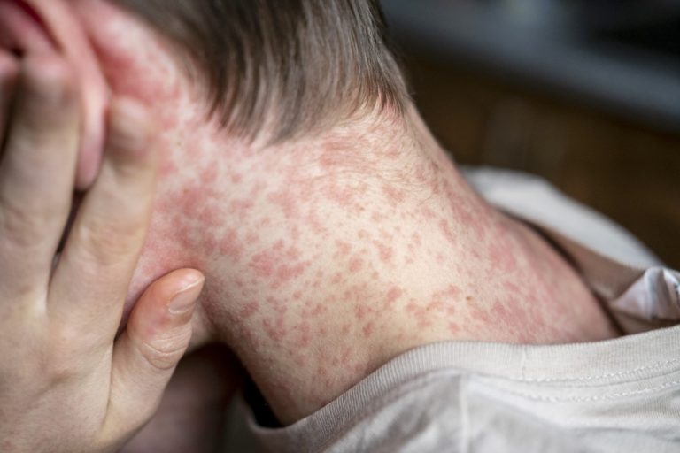 Texas Reports Fifty-Six New measles Cases in Continued outbreak