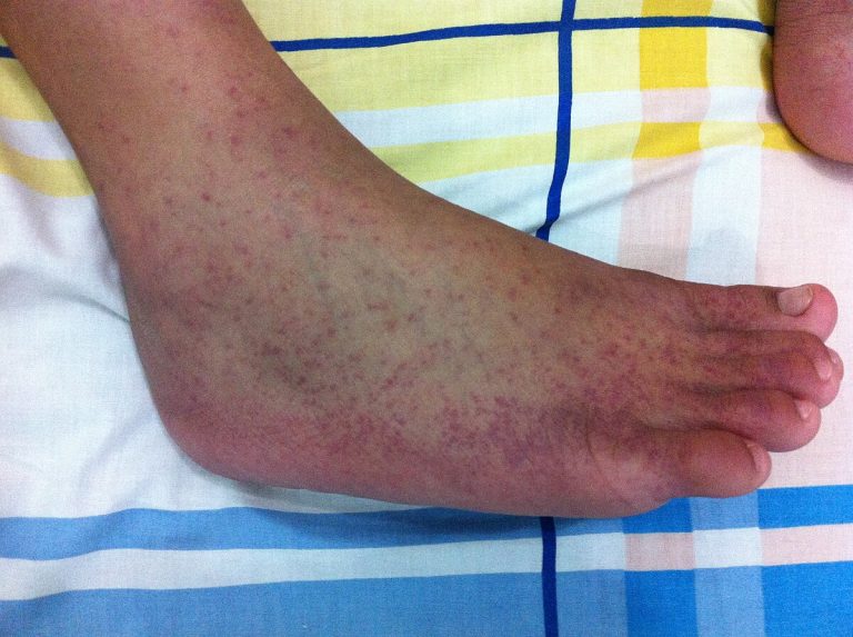 Eliminating mosquitoes not enough to fight China’s chikungunya fever outbreak, experts say