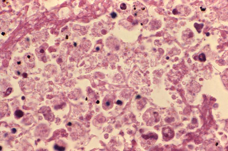 New York City Health Department Provides Update on Community Cluster of Legionnaires’ Disease in Central Harlem