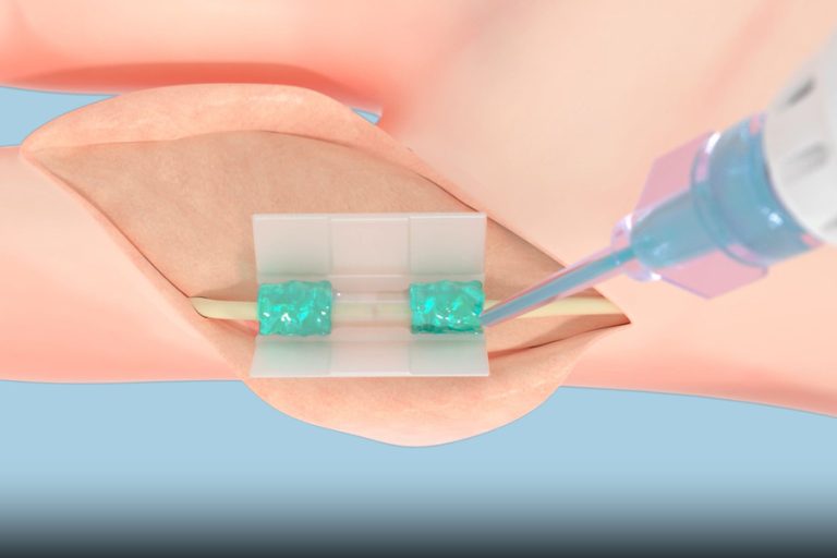 MIT spinout Tissium secured FDA marketing authorization of biopolymer platform for nerve repair
